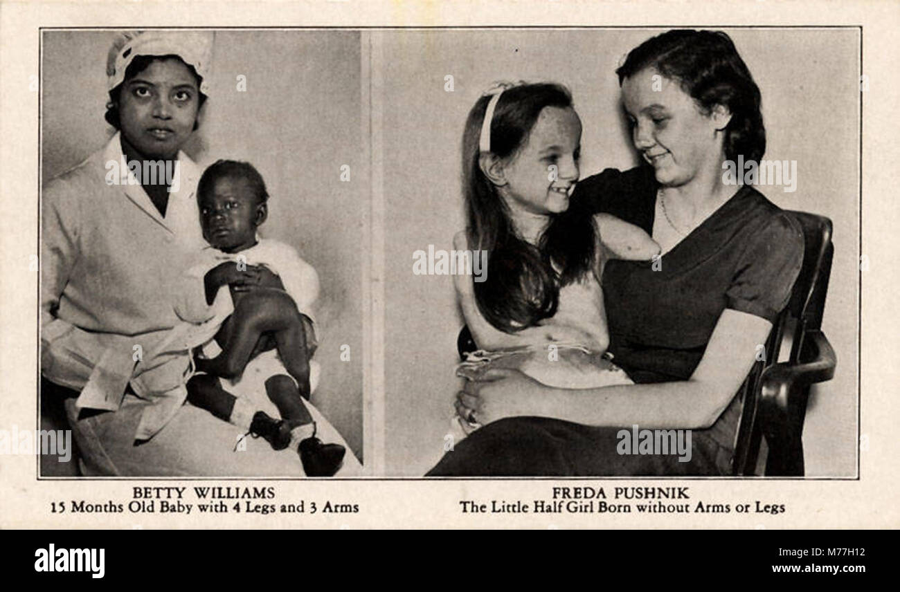 Betty Williams, 15 mois bébé avec 4 jambes et 3 bras ; Freda Pushnik, La  petite fille de la moitié... Npar (415670 Photo Stock - Alamy