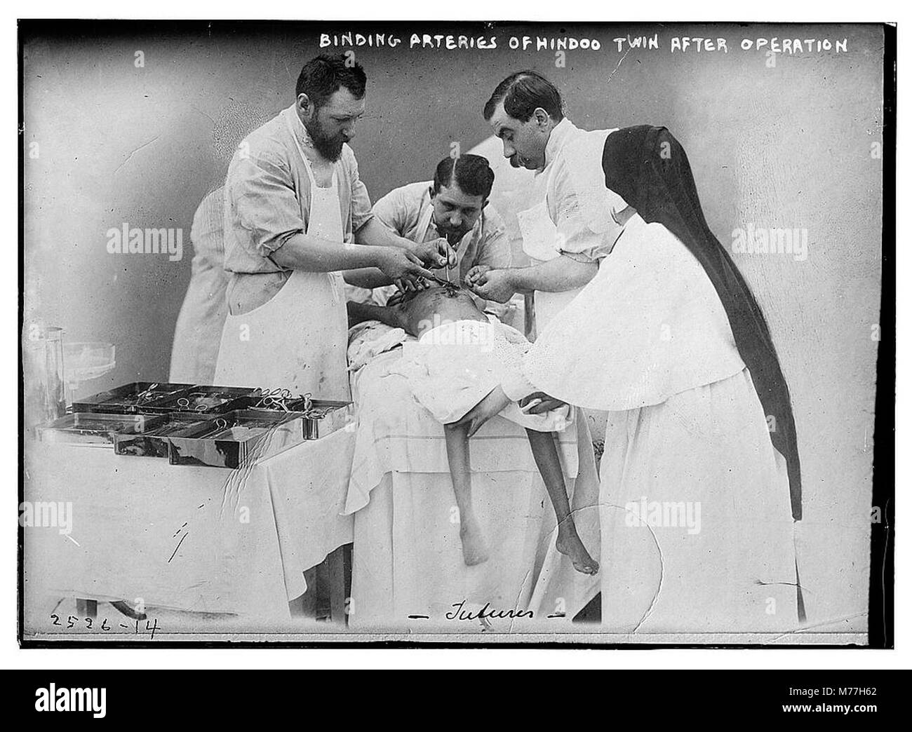 Une photographie médicale montrant la procédure de liaison des artères de jumeaux conjoints après une opération, documentant une intervention chirurgicale importante dans l'histoire médicale. Banque D'Images