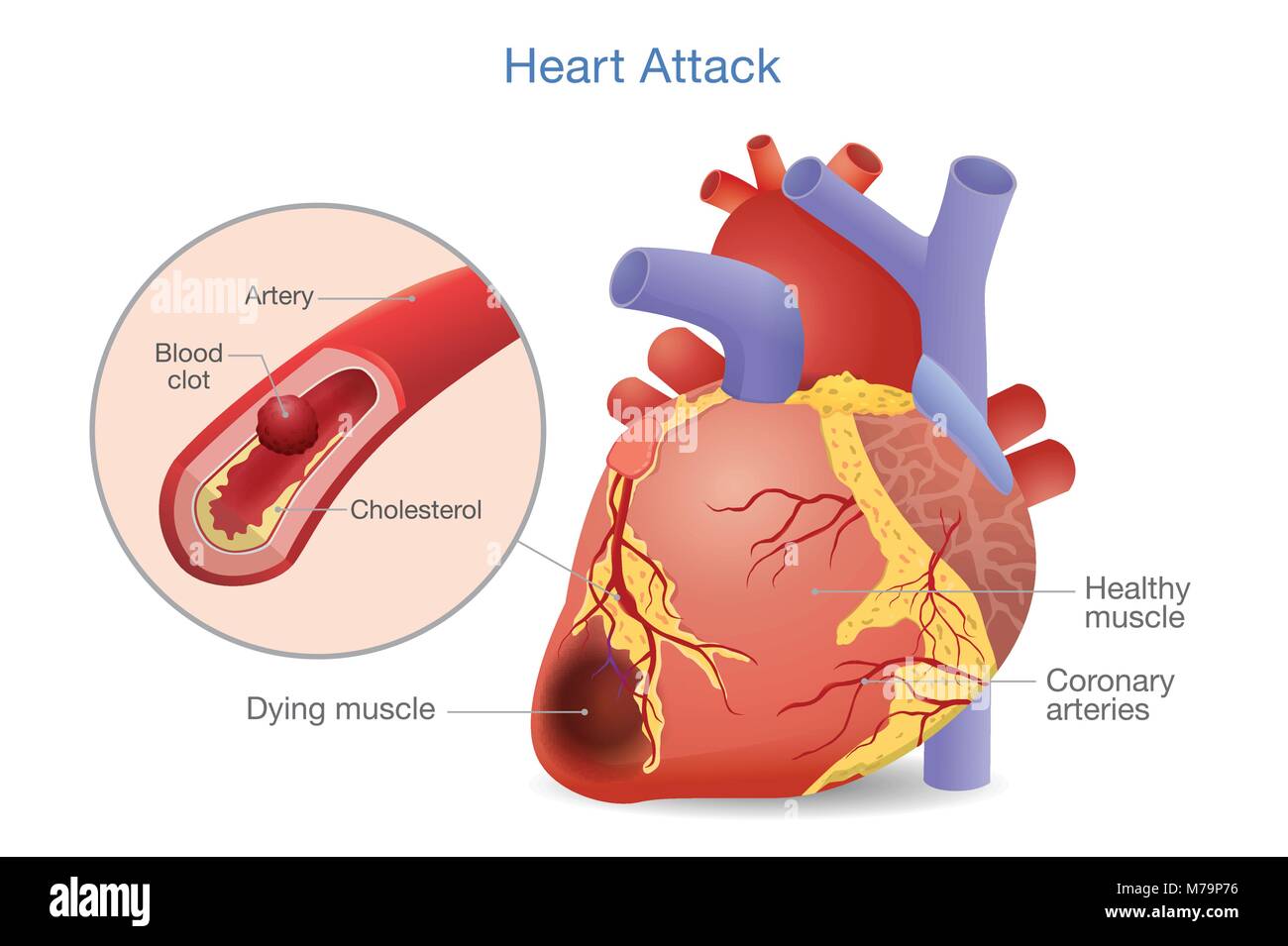 Illustration de la thrombose est un caillot de sang qui se développe à la crise cardiaque. Illustration de Vecteur