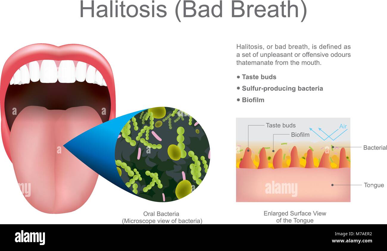 L'halitose ou mauvaise haleine. Info L'éducation graphique. La conception de scénario. Illustration de Vecteur