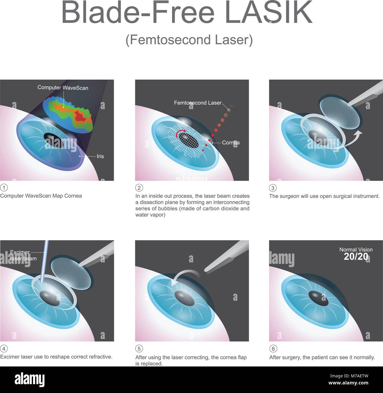 La méthode utilisée par les lasers LASIK sans lame pour créer des volets de la cornée est revendiquée pour améliorer la sécurité de la chirurgie LASIK. Illustration de Vecteur