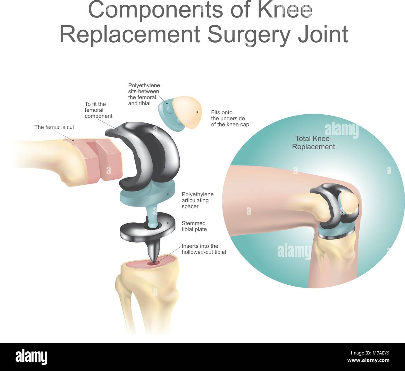 Composantes de la chirurgie de remplacement du genou joint Illustration de Vecteur