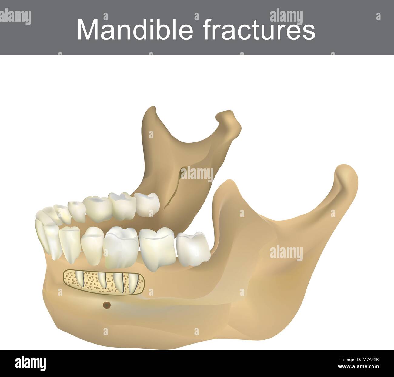 Les fractures de la mandibule est le plus grand, le plus fort et le plus faible face à l'os. Une partie de corps humain. L'infographie de l'anatomie. Illustration de Vecteur