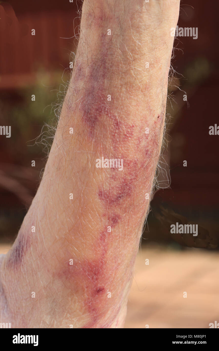 Ecchymose (hématome) causé par une hémorragie interne à la suite d'un test de sang ayant été effectuée. Banque D'Images