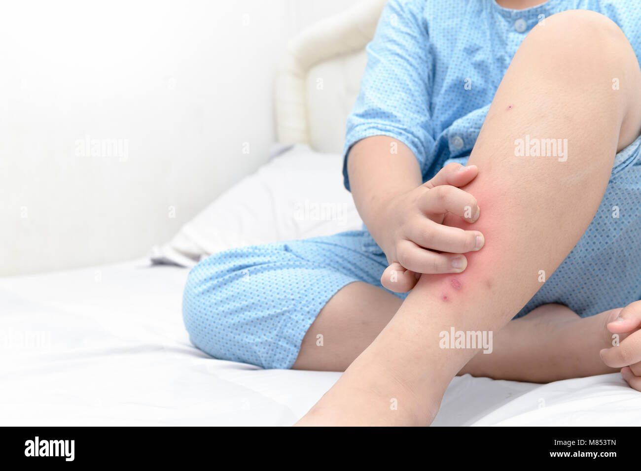 Le grattage à la main ,les jambes de fat boy avec gonflement douloureux et spot ,cicatrice de moustiques piquent allergie, concept de soins de santé Banque D'Images