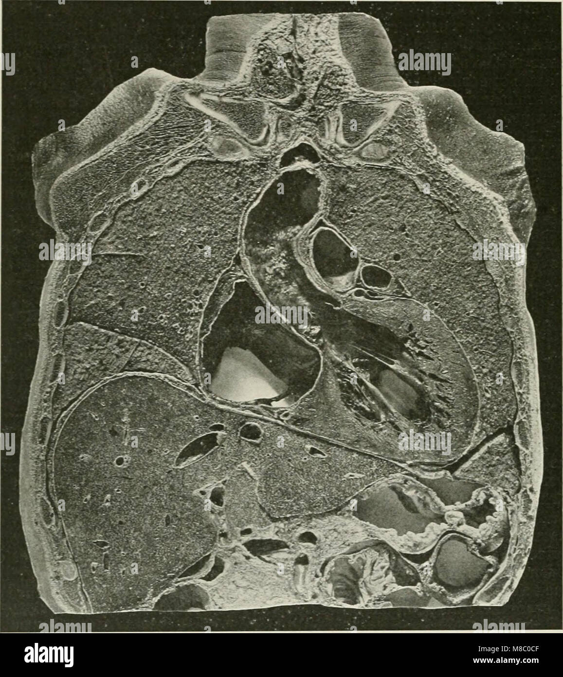 Les maladies de la poitrine et les principes de diagnostic physique (1920) (14757076916) Banque D'Images