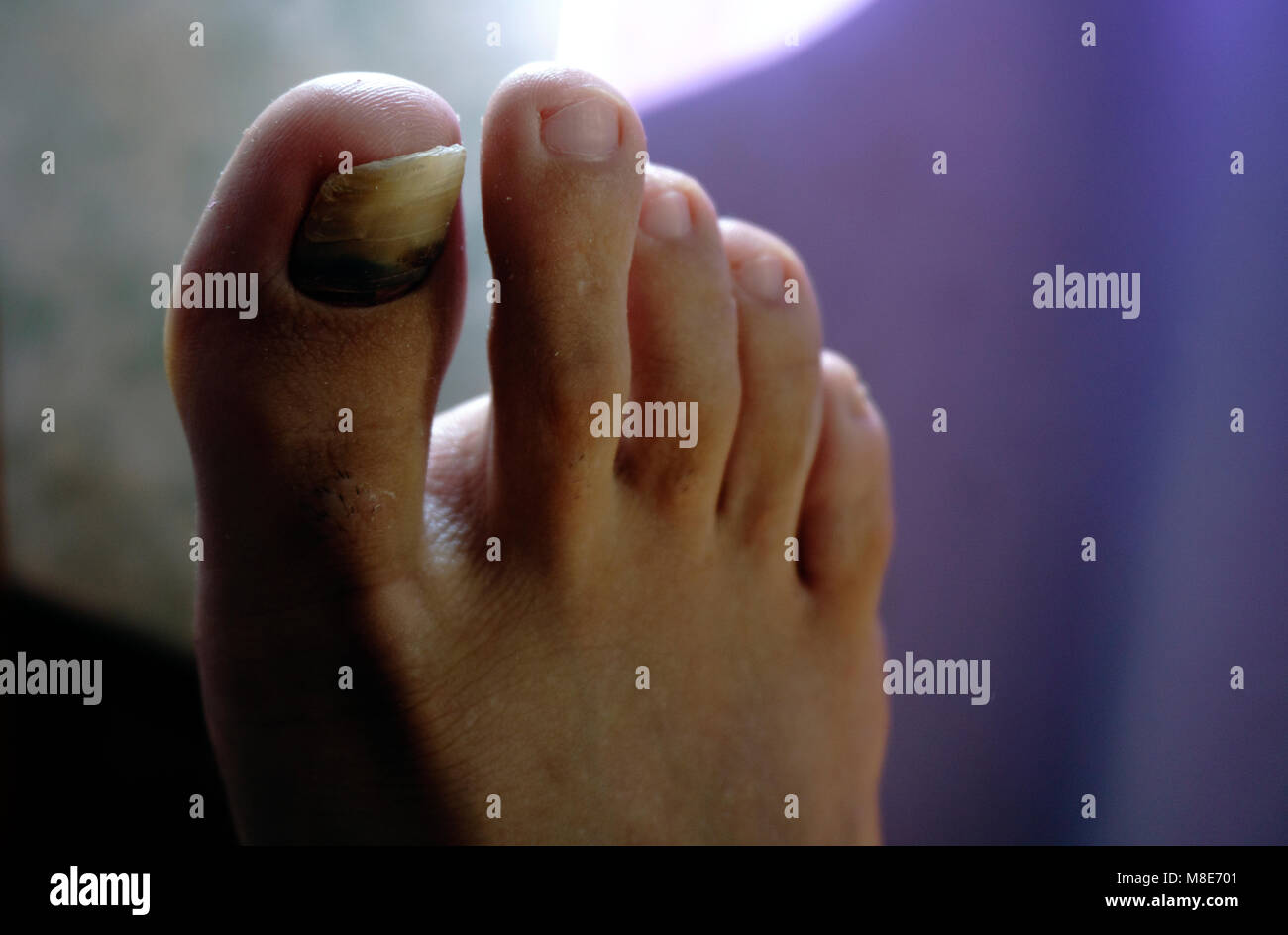 Mycose Ongle Avec Arthrite Banque D Image Et Photos Alamy Mycose Ongle Avec Arthrite Banque D Image Et Photos Alamy