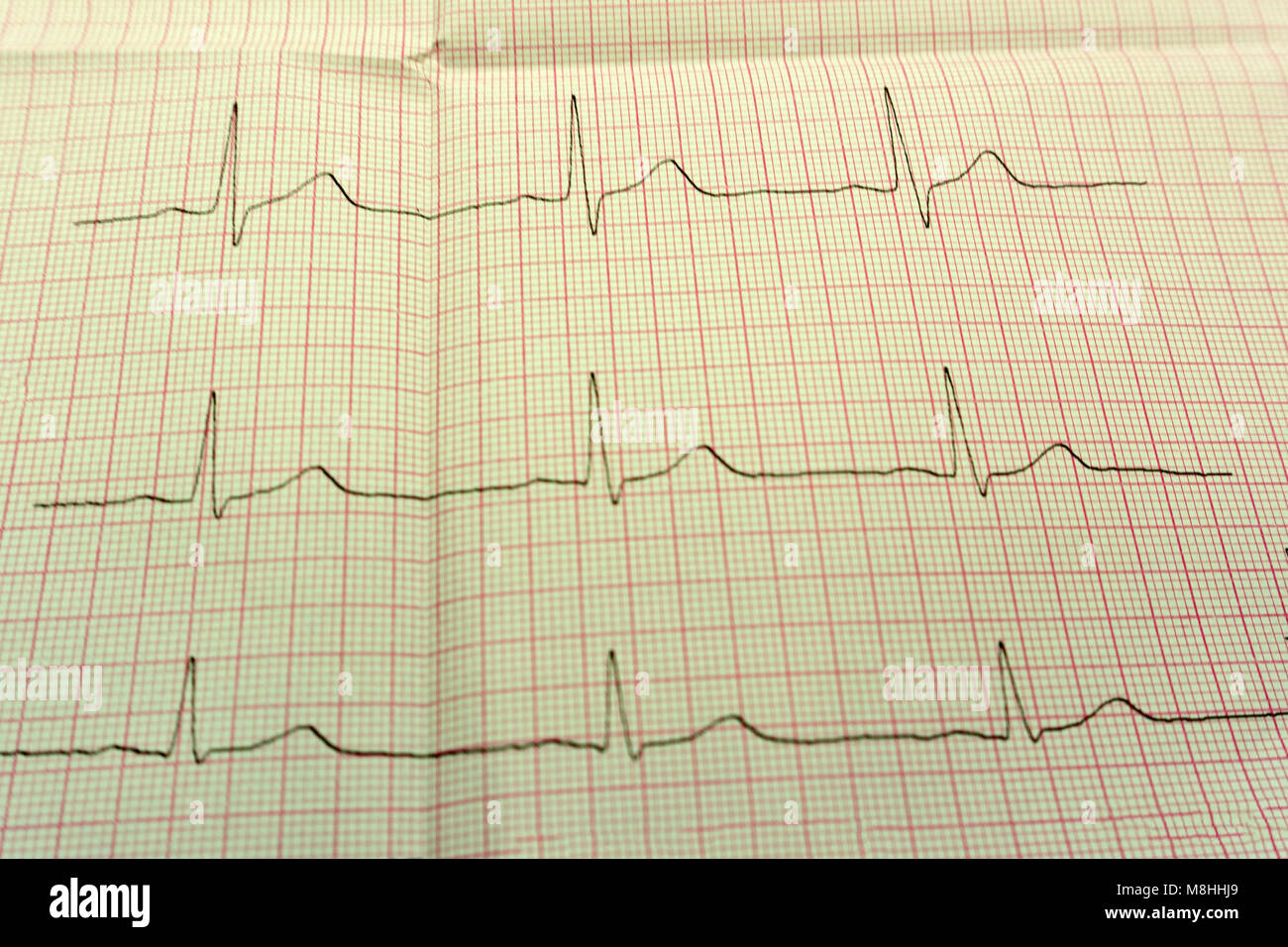 Extrasystole sur l'enregistrement de l'électrocardiogramme 12 dérivations Paper Banque D'Images
