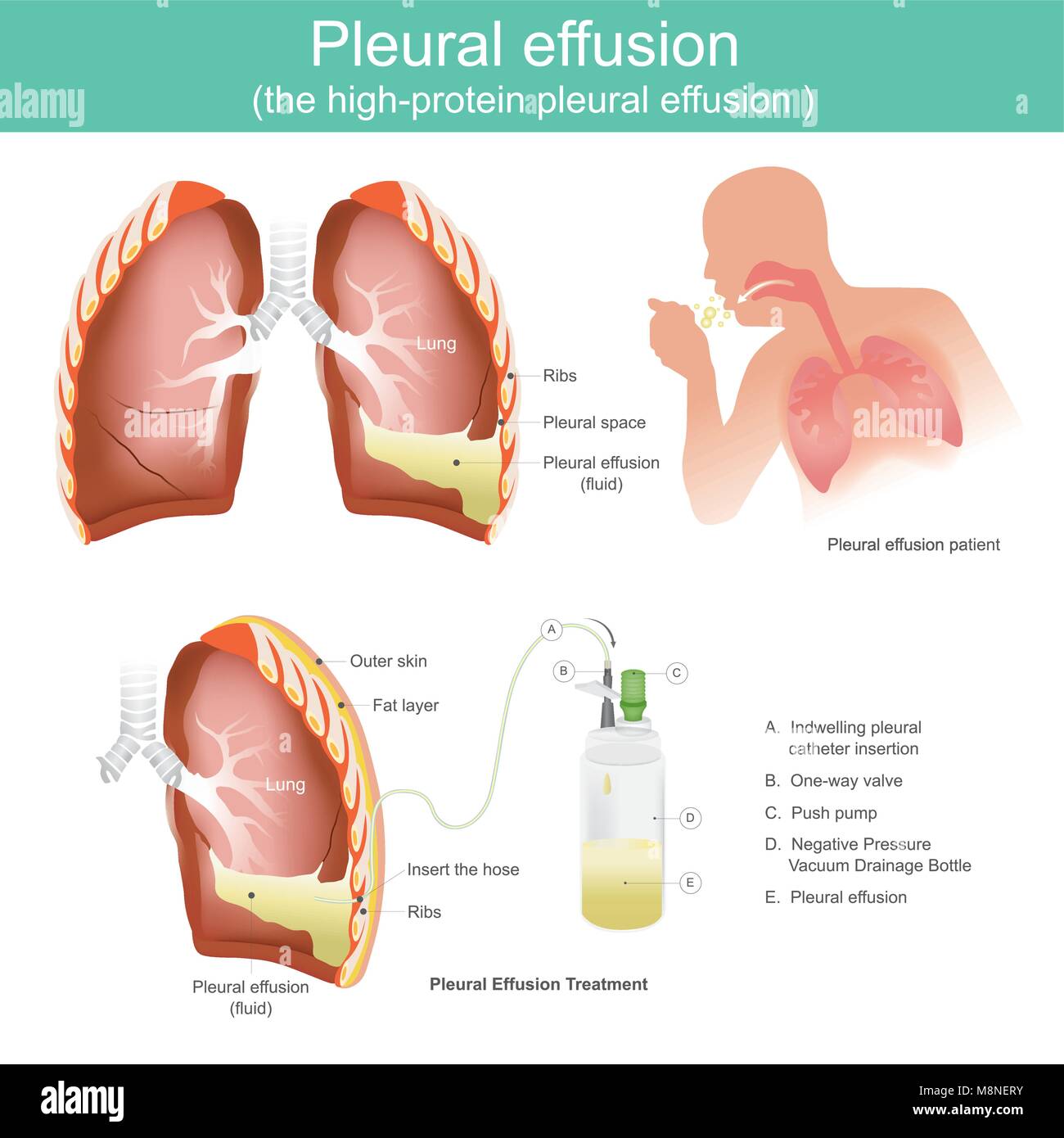 L'épanchement pleural est une accumulation de liquide dans la poitrine ou dans le poumon. L'épanchement pleural est traitement en suçant dehors. Illustration Illustration de Vecteur