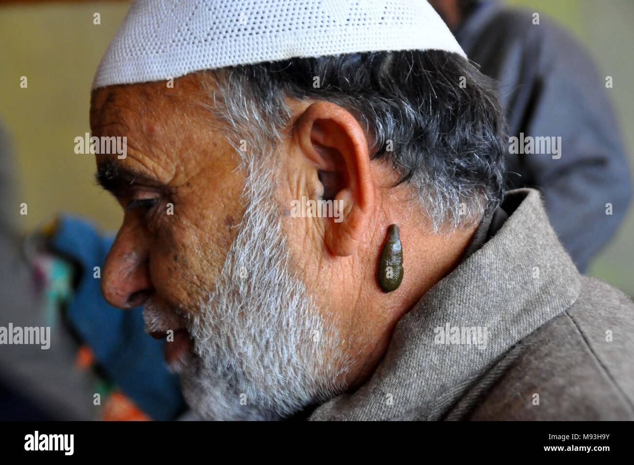 L'Inde, d'Anantnag. Mar 21, 2018. Un homme reçoit du Cachemire leech  thérapie sur 20 Mars, 2018 dans Malaknag Anantang, 48 kilomètre de la  capitale d'été de la partie du Cachemire administrée par