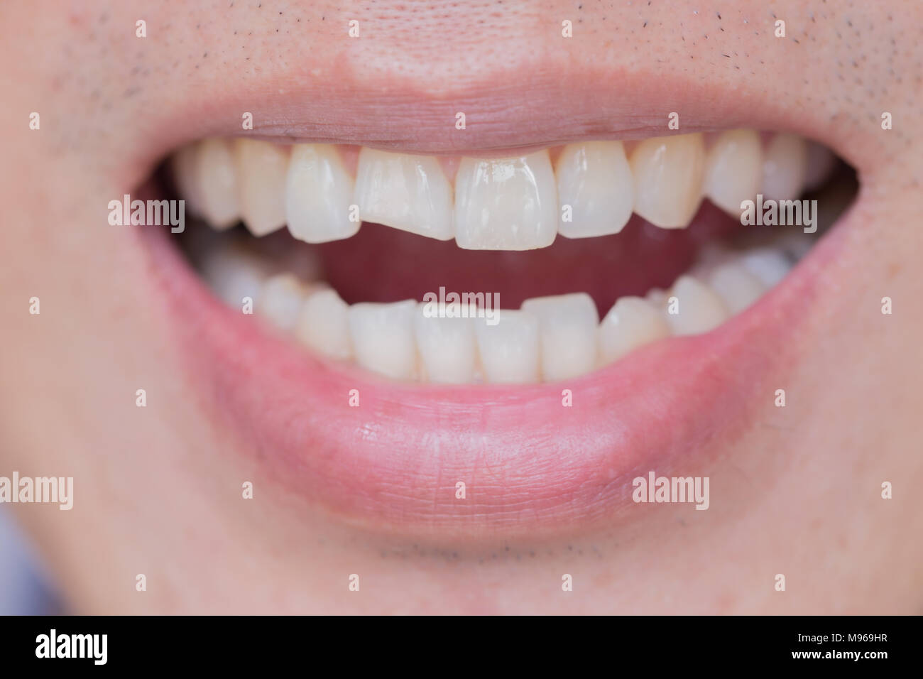 Les blessures ou les dents Dents de rupture dans le mâle. Les traumatismes et d'un nerf de la dent, les dents permanentes de blessés graves. Banque D'Images