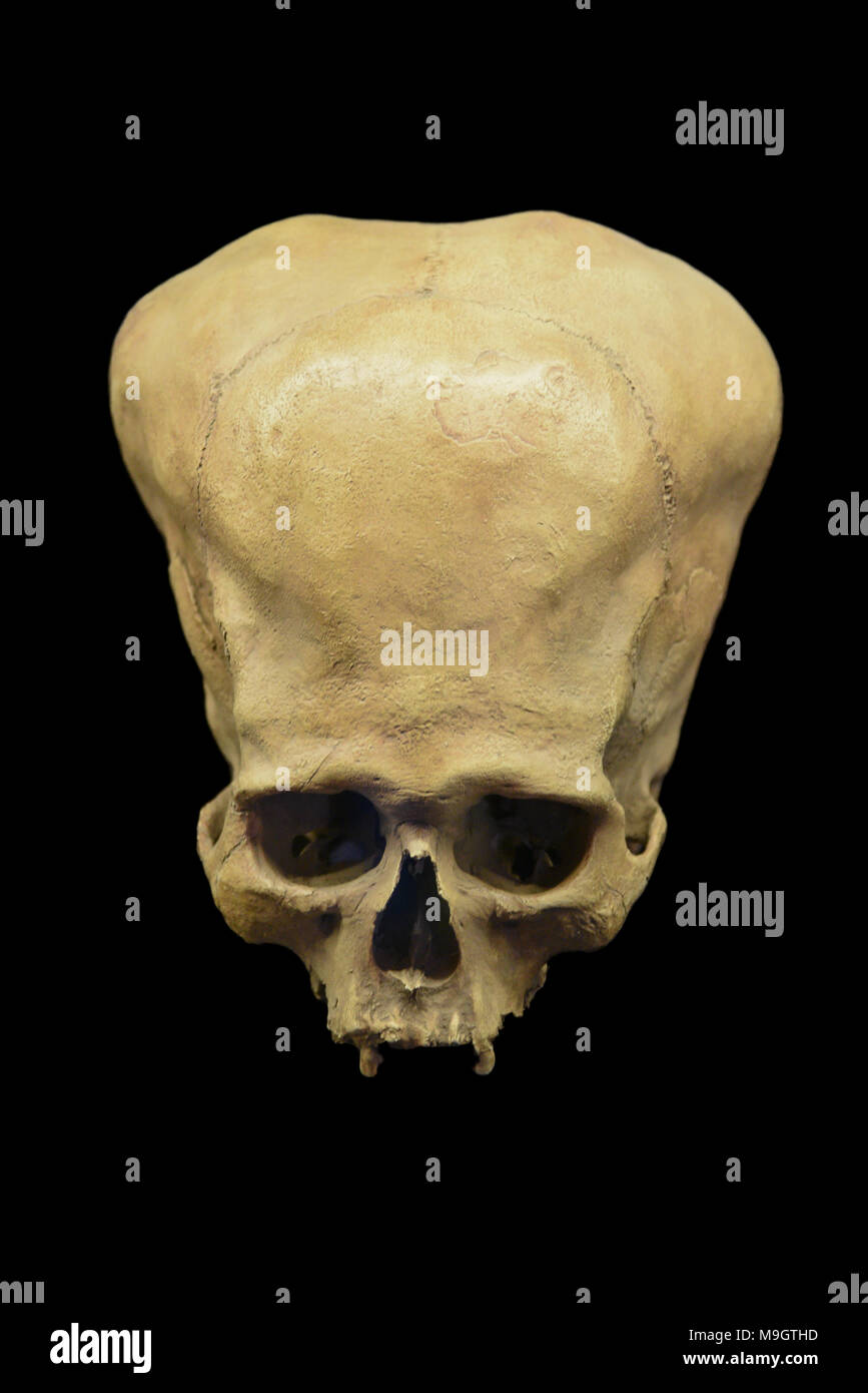 Péruvienne crâne déformé Banque D'Images