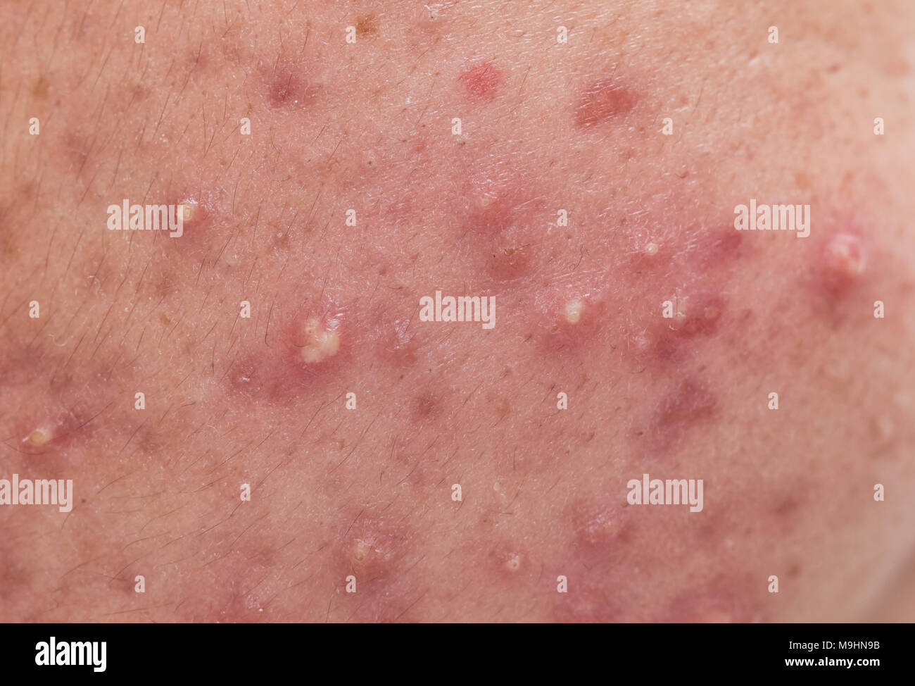 Libre de problèmes de peau, de peau d'acné kystique nodulaire Photo ...