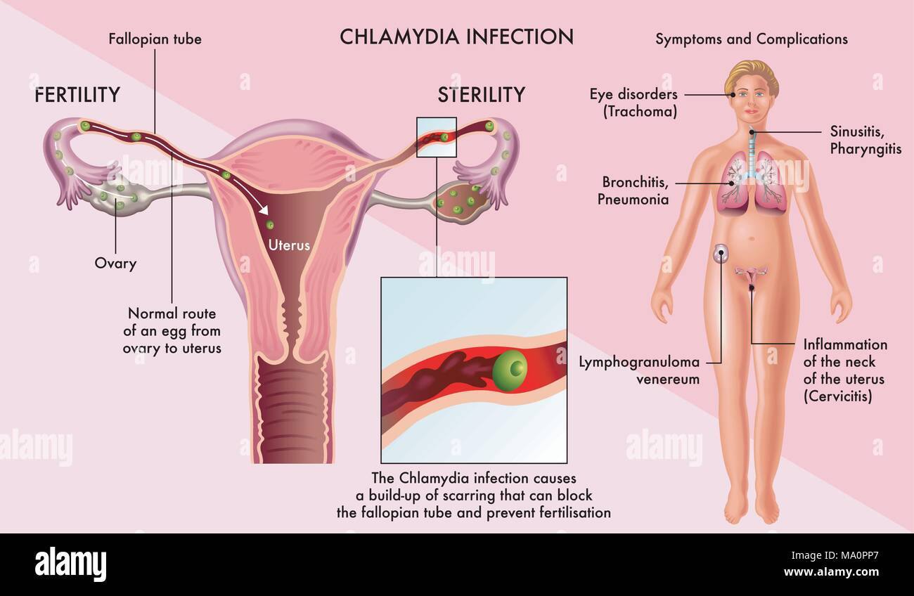 Illustration médicale des symptômes et complications de l'infection à Chlamydia chez la femme Illustration de Vecteur
