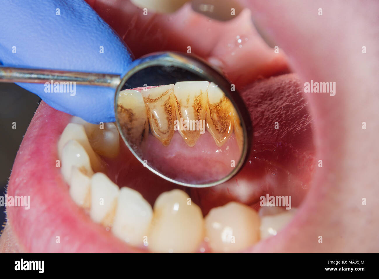 La carie dentaire. Remplissage avec des matériaux composites dentaires utilisant rabbders photopolymères. Le concept de soins dentaires dans une clinique dentaire Banque D'Images
