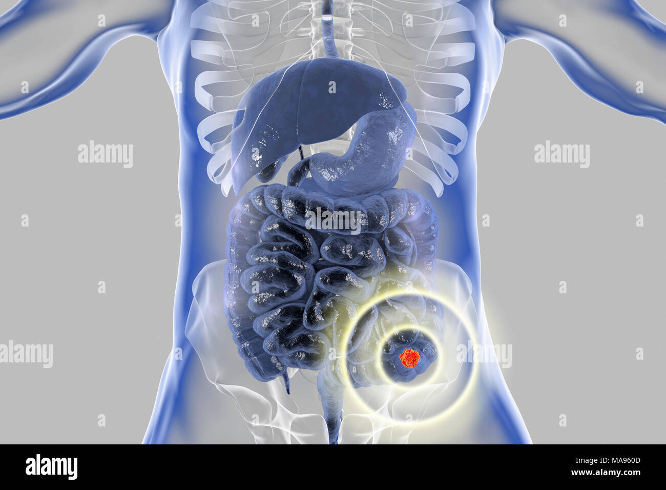 Traitement du cancer du côlon, l'illustration de l'ordinateur conceptuel. Banque D'Images
