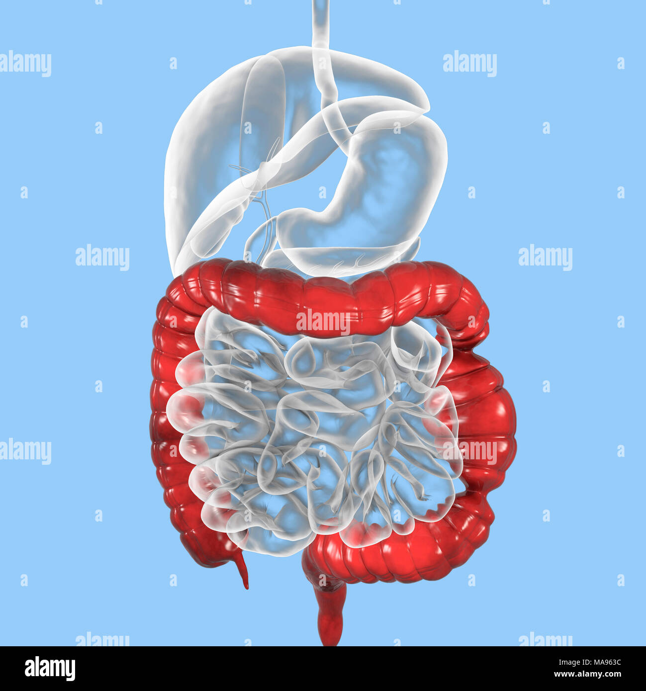 Le syndrome du côlon irritable. Illustration d'un système digestif souffrant du syndrome du côlon irritable (SCI). IBS est également connu sous le nom de côlon spastique ou syndrome du côlon irritable. Il provoque des douleurs abdominales et des crampes, et des habitudes intestinales comme la constipation et la diarrhée. L'état est pensé pour être liés à l'anxiété et le stress, qui perturbent les mouvements musculaires involontaires dans les intestins. Il n'y a pas de remède, mais anti-diarrhéiques, laxatifs et de médicaments anti-spasmodiques peuvent aider à soulager les symptômes. L'augmentation de la consommation de fibres et d'eau dans l'alimentation, et en diminuant le stress est également recommandé. Banque D'Images
