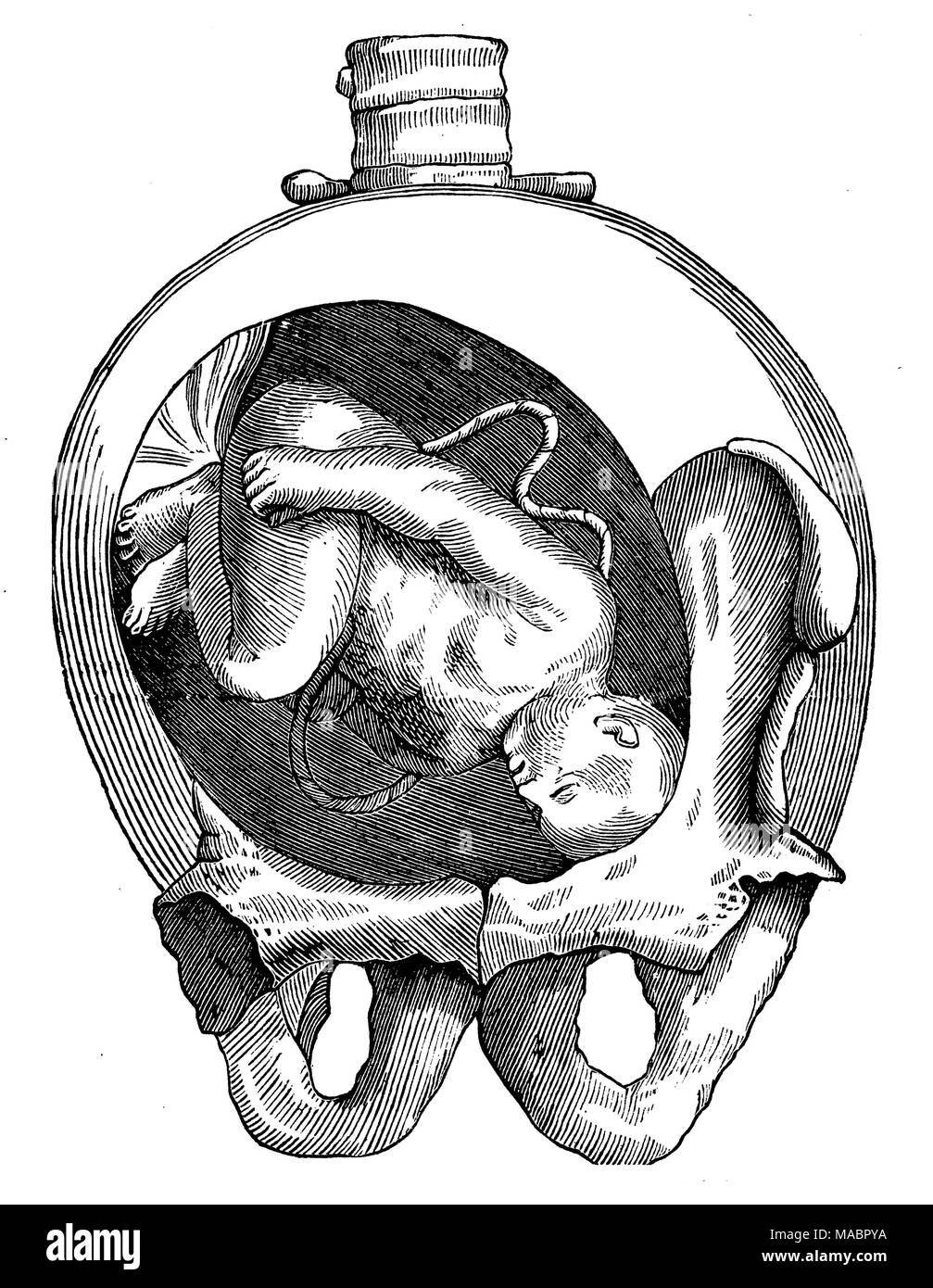 Position d'un enfant dans l'utérus : position oblique de la tête Banque D'Images