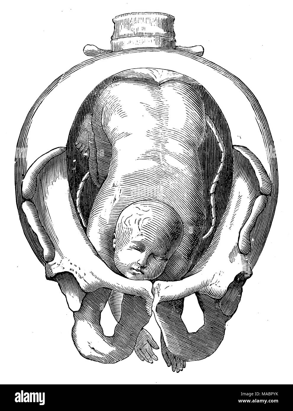Position d'un enfant dans l'utérus : prolapsus de deux bras Banque D'Images