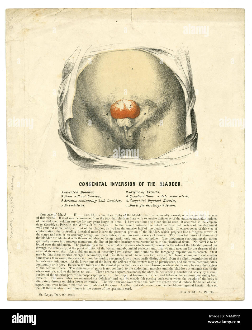 Titre : affiche de la médecine illustrée, imprimé, montrant les effets de l'Inversion congénitale de la vessie, le 20 décembre 1848 . 20 décembre 1848. Le pape, Charles A. (Charles Alexander), 1818-1870 Banque D'Images