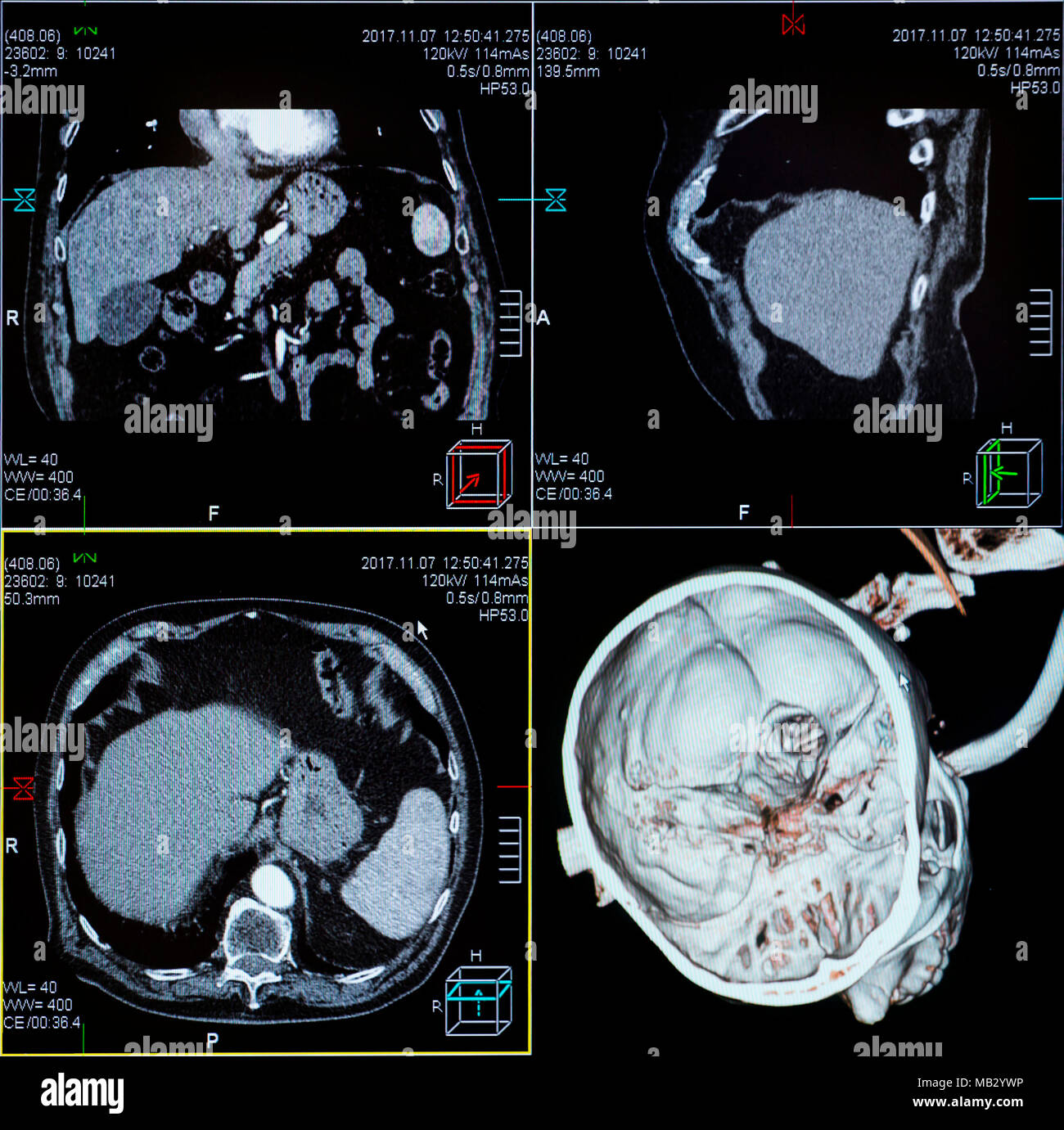 L'imagerie par résonance magnétique (IRM) - CT scan de la tête sur un moniteur d'ordinateur d'échographie. Banque D'Images