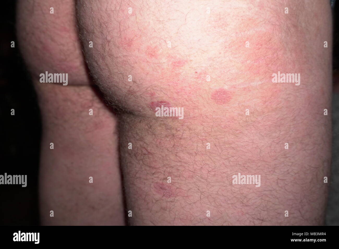 Lymphome Banque D Image Et Photos Alamy