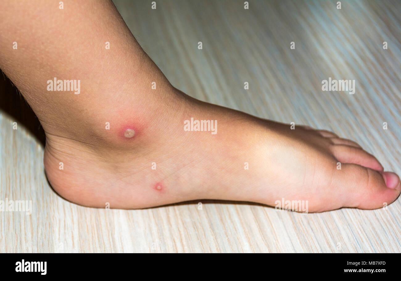 Gros plan du virus de la varicelle ou la varicelle de l'enfant bulle éruption sur la jambe ou le pied. Concept de dermatologie. Banque D'Images