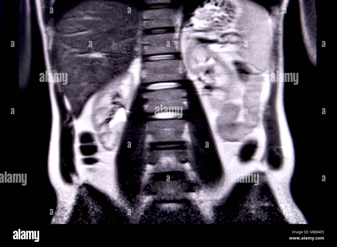 Balade à travers les droits de l'abdomen et la poitrine à l'aide d'IRM 18 coupes (vue coronale). Photo 9/18 Banque D'Images