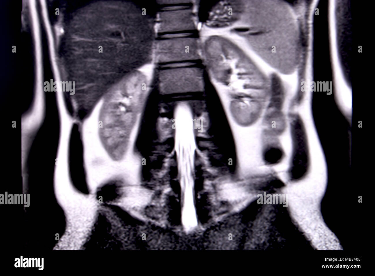 Balade à travers les droits de l'abdomen et la poitrine à l'aide d'IRM 18 coupes (vue coronale). Photo 11/18 Banque D'Images