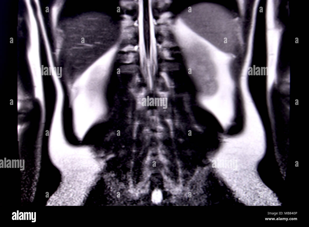 Balade à travers les droits de l'abdomen et la poitrine à l'aide d'IRM 18 coupes (vue coronale). Photo 14/18 Banque D'Images