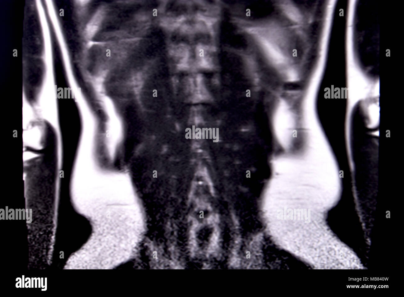 Balade à travers les droits de l'abdomen et la poitrine à l'aide d'IRM 18 coupes (vue coronale). Photo 16/18 Banque D'Images