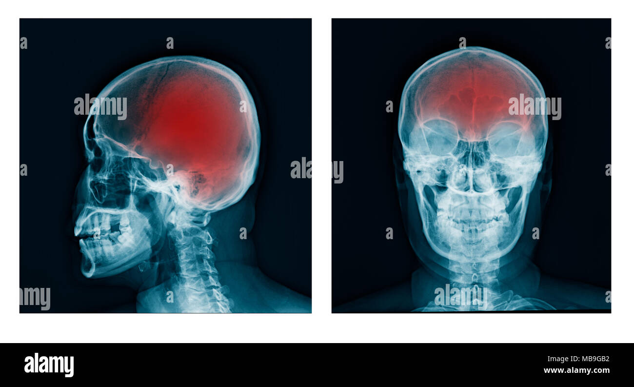 Skull x-ray AP/vue latérale. Banque D'Images