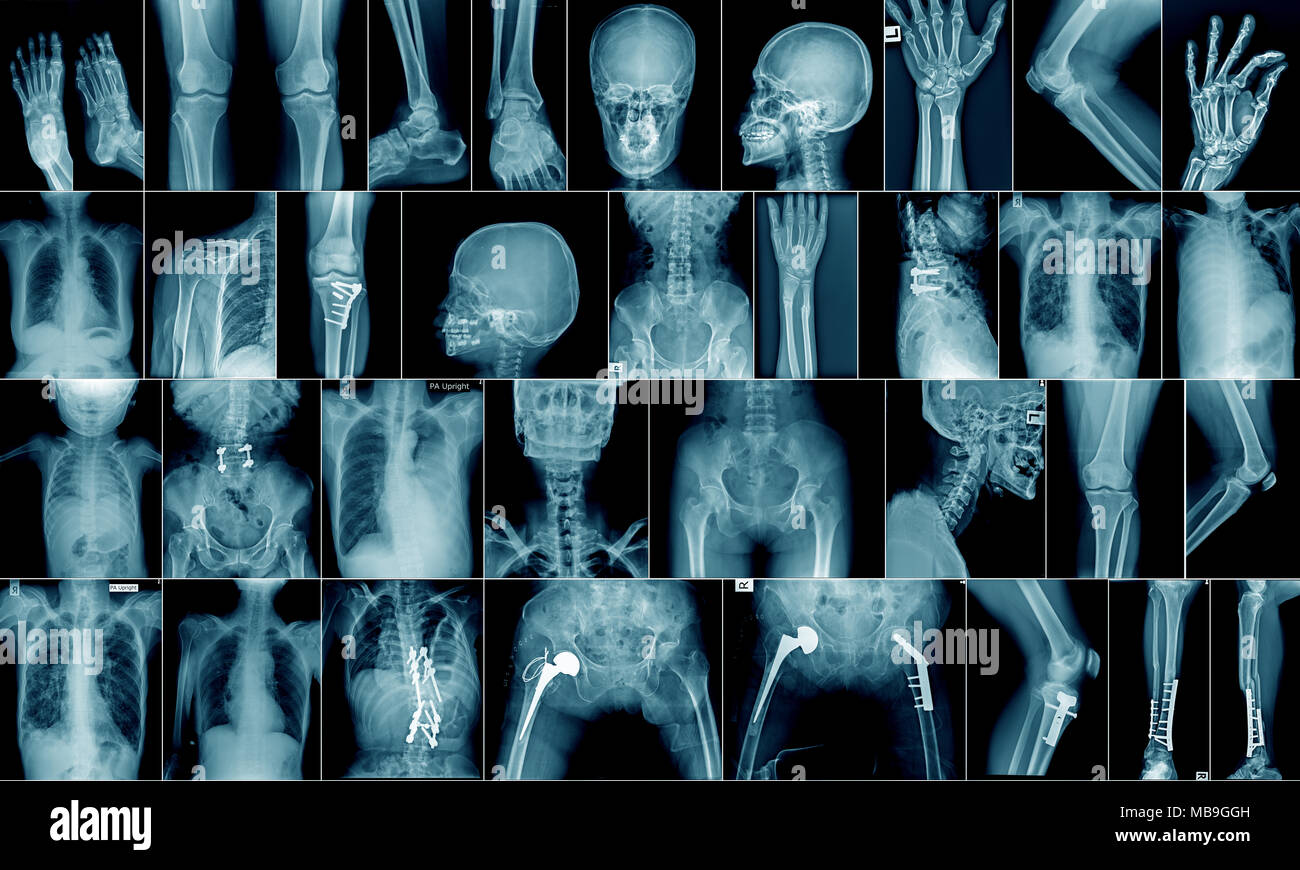 X-ray haute qualité collection partie du corps et la zone de fracture Banque D'Images