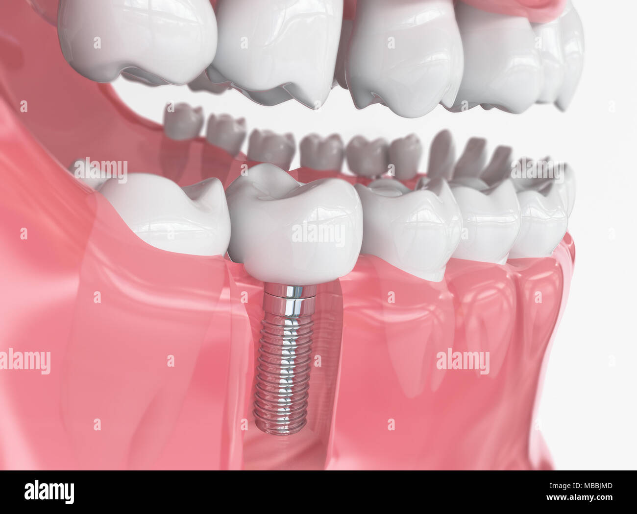 Des dents implant - le rendu 3D Banque D'Images