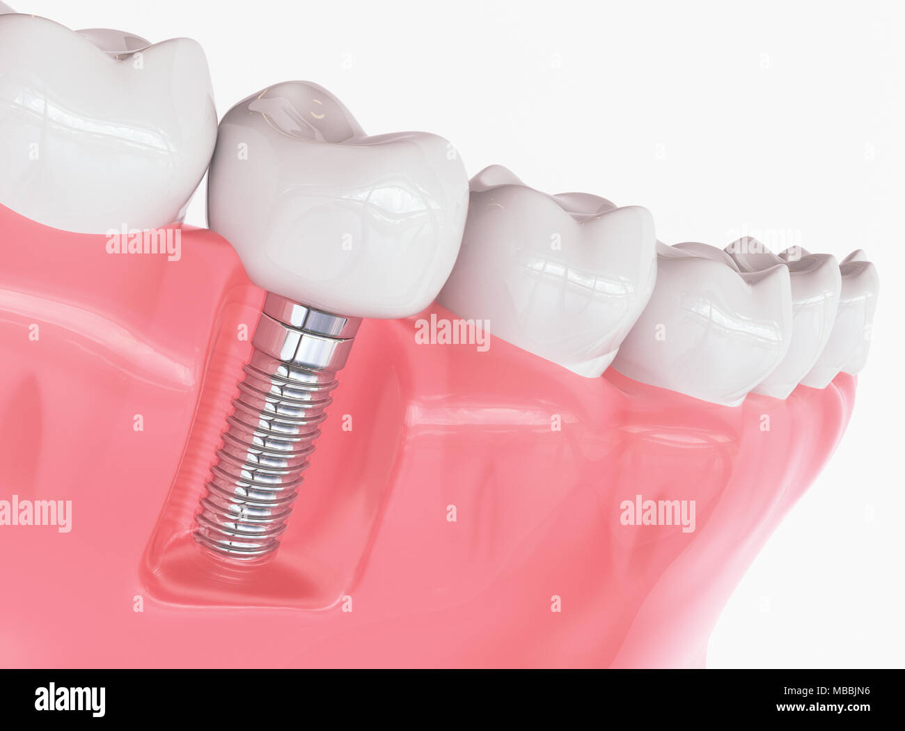 Des dents implant - le rendu 3D Banque D'Images