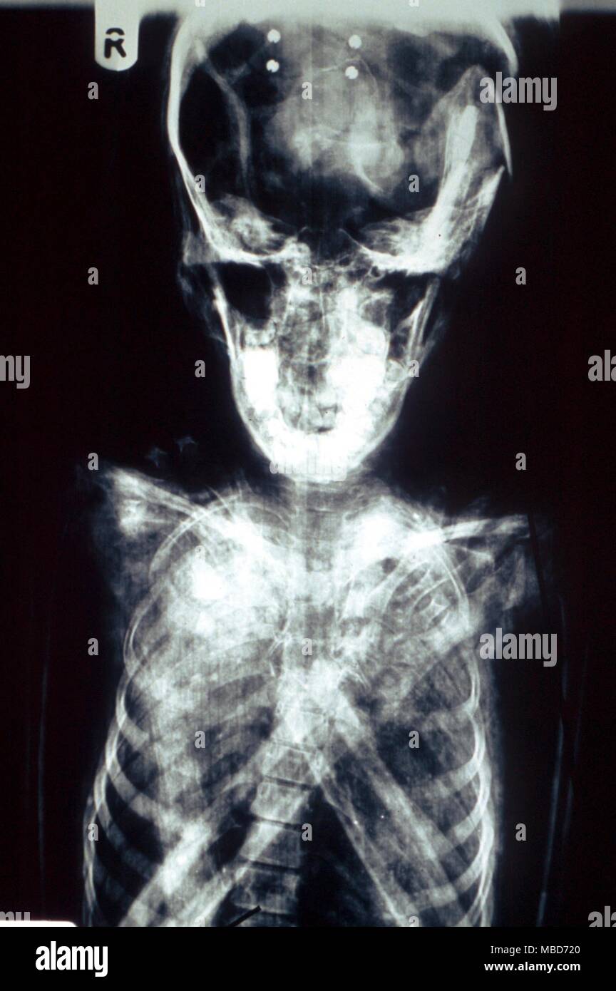 X-ray de crâne de momie de la période ptolémaïque. La momie est celle d'une jeune fille qui est morte d'un accident dans lequel sa tête a été écrasée, et ses cuisses se sont enfoncés dans le bassin. Musée du Château Cliffe en Keighley Banque D'Images