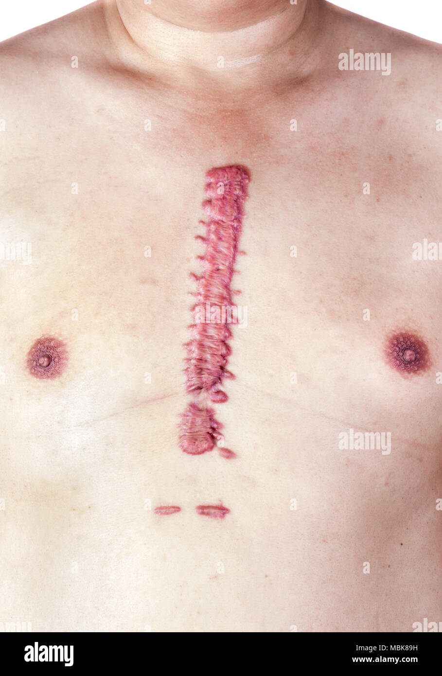 La cicatrice hypertrophique ou la cicatrix de houle est grande et longue, convexe et grande. Sur la poitrine, la peau est rose et rouge. Se produit après une intervention chirurgicale. Banque D'Images