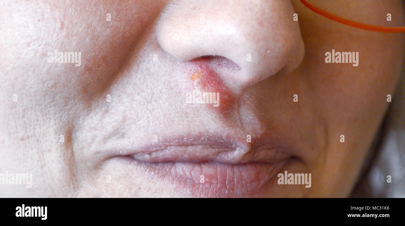 L'Herpès sous le nez la jeune femme.image d'un Photo Stock - Alamy
