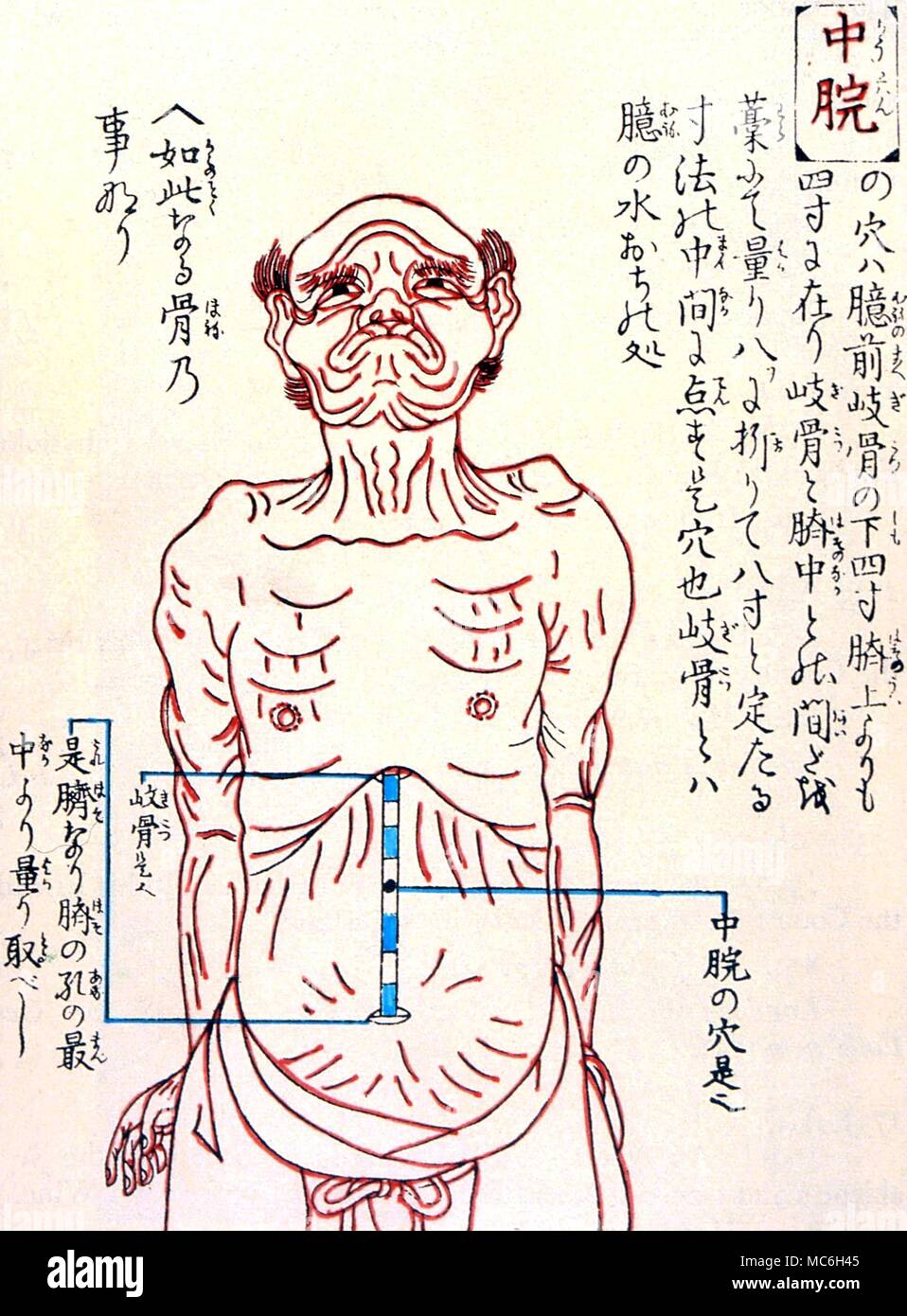 Acupuncture - acuponcture chinoise graphique, à partir d'une gravure sur bois de 1730 Banque D'Images