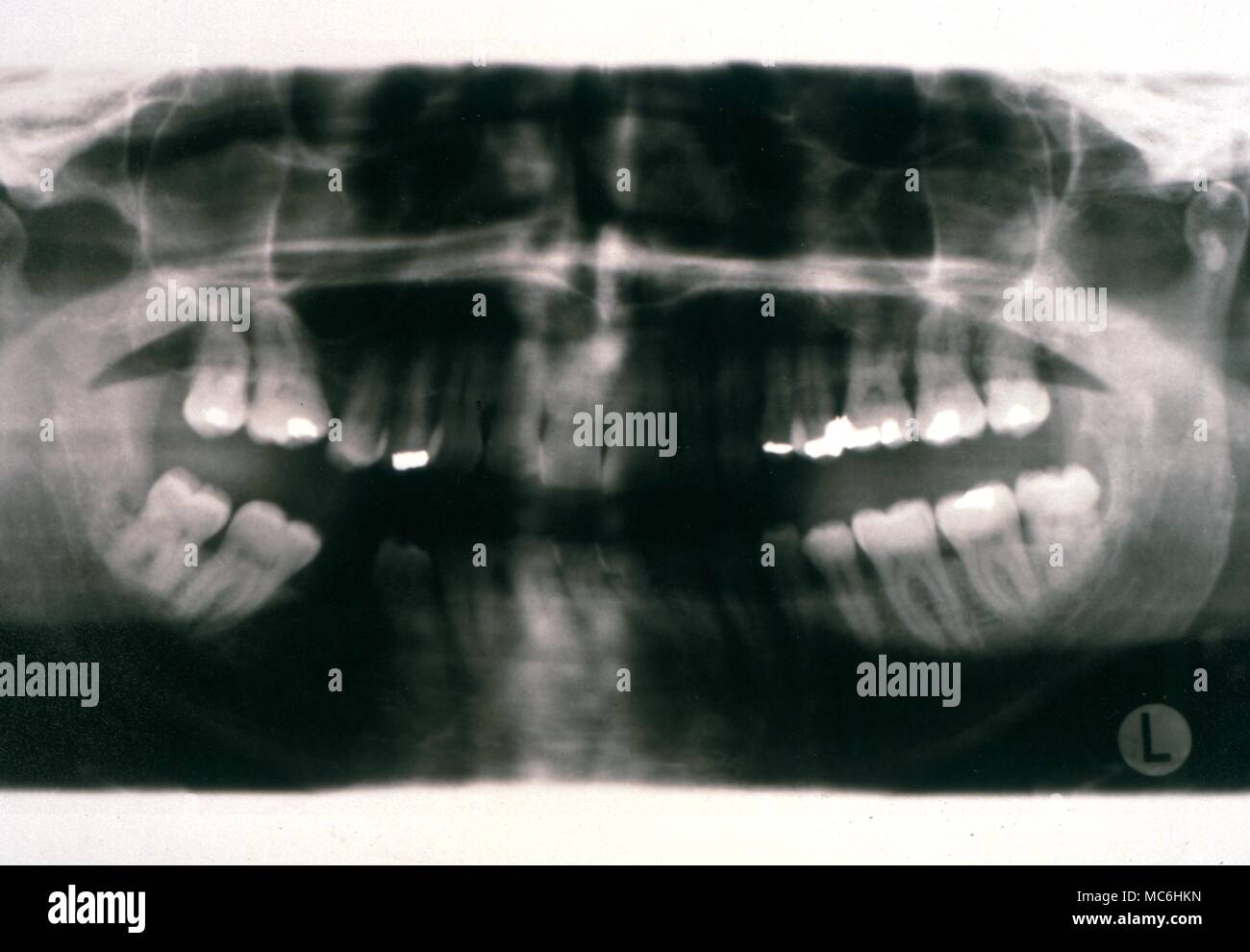 Medical -X-Ray de la mâchoire humaine Banque D'Images