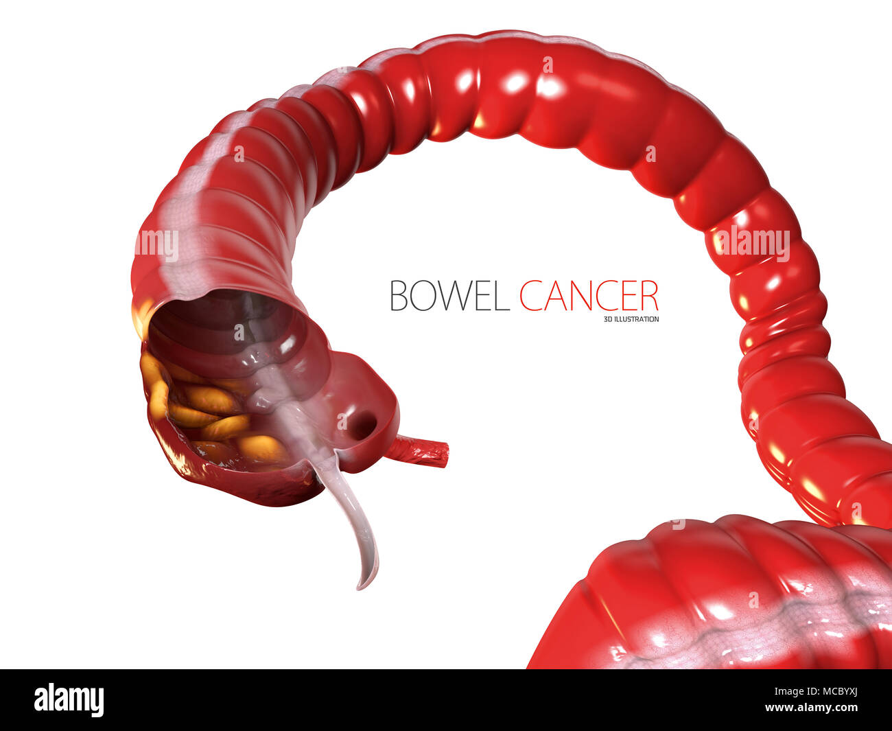 Illustration 3d de cancer colorectal, isolé sur fond blanc Banque D'Images