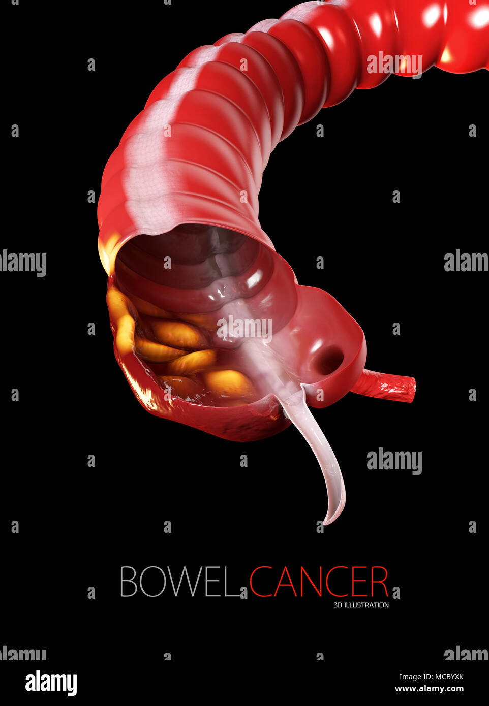 Le cancer colorectal, fond noir isolé 3d illustration Banque D'Images