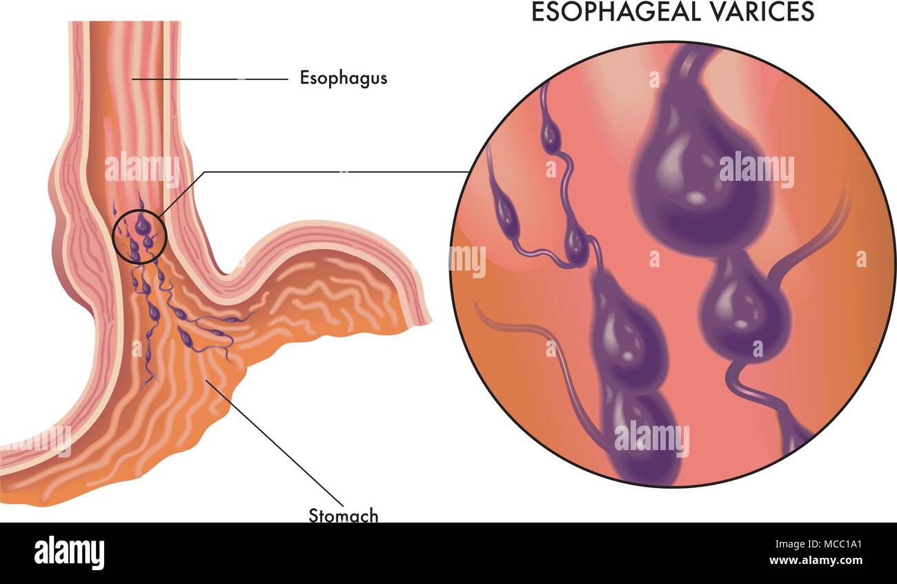 Une illustration médicale des symptômes de varices oesophagiennes Illustration de Vecteur