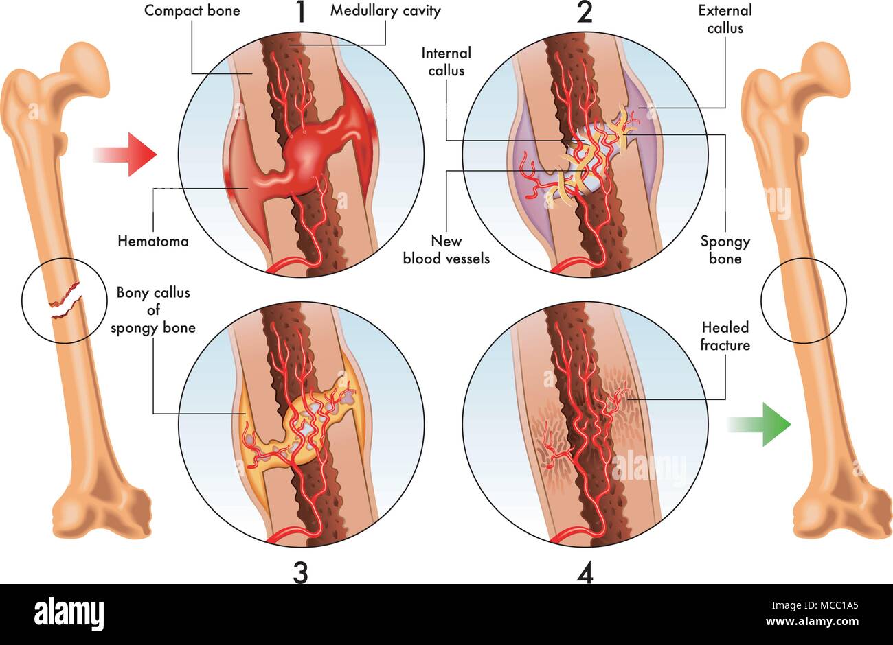 Vector illustration médicale d'étapes de réparation de fracture osseuse Illustration de Vecteur