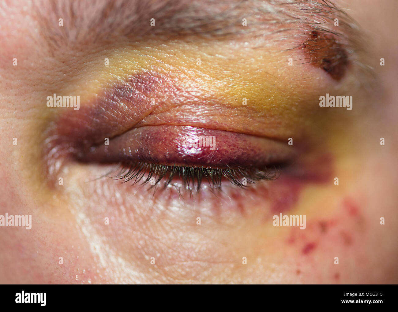 Un homme avec un œil noir. Banque D'Images