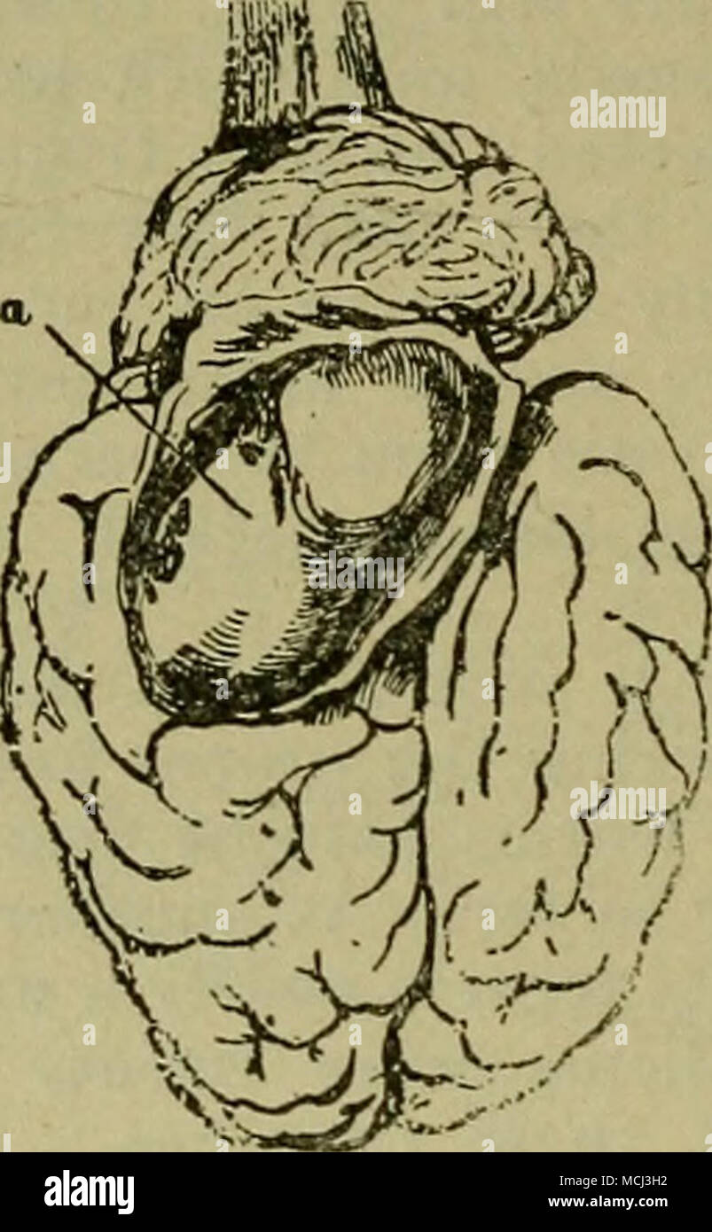 Kyste Dans Le Cerveau Banque D Image Et Photos Alamy