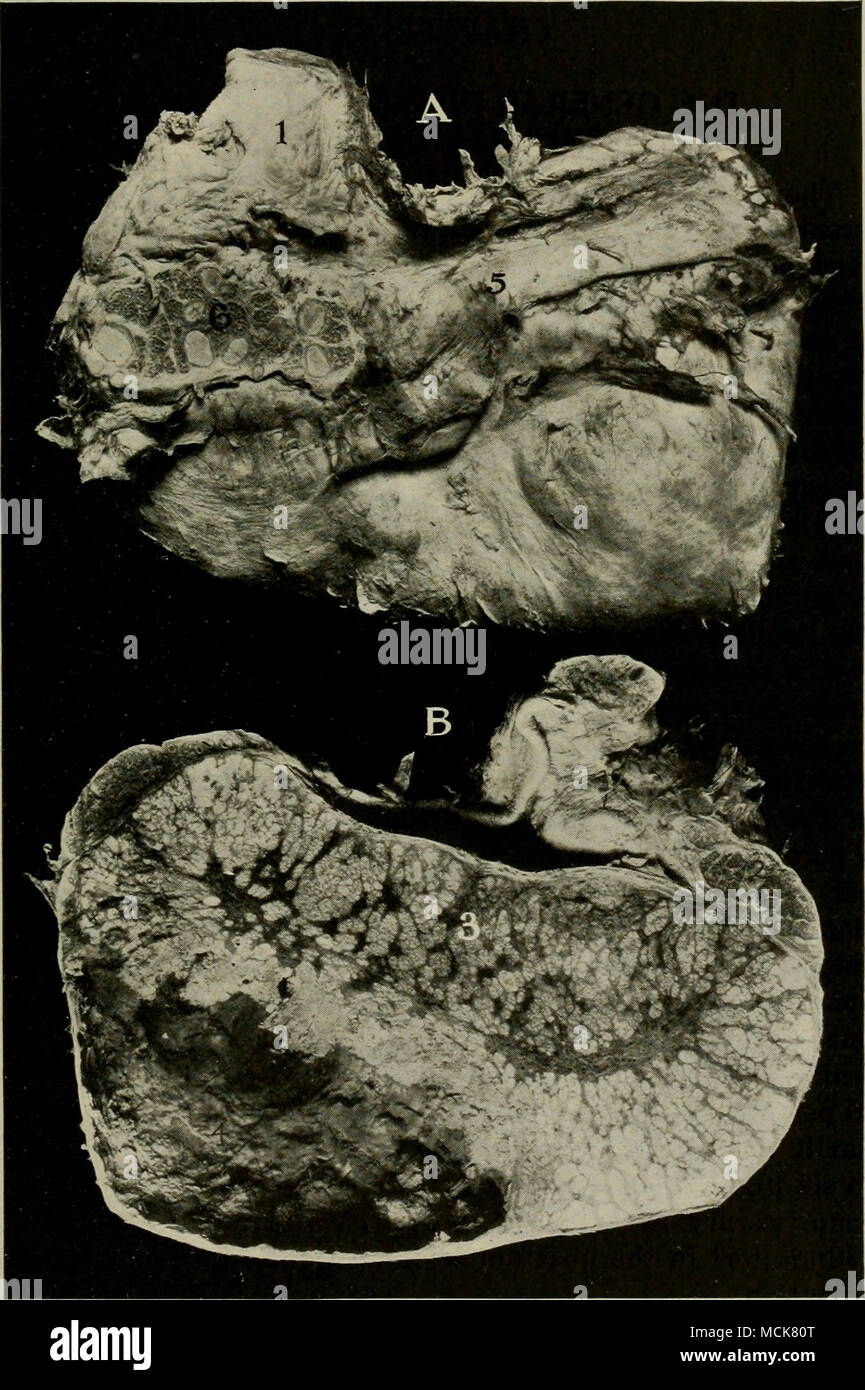 . Fig. 215-Tuberculose du testicule. Sanglier. A, B, section médiane ; face externe du testicule montrant l'épididyme. / Cordon spermatique, ; 2, chef de l'epididj-mis ; j, masses tuberculeuses ; 4, tuber- culière cavité ; abcès 5, corps de l'épididyme : 6, section à travers l'épididyme révélant des masses tuberculeuses. 47 Banque D'Images