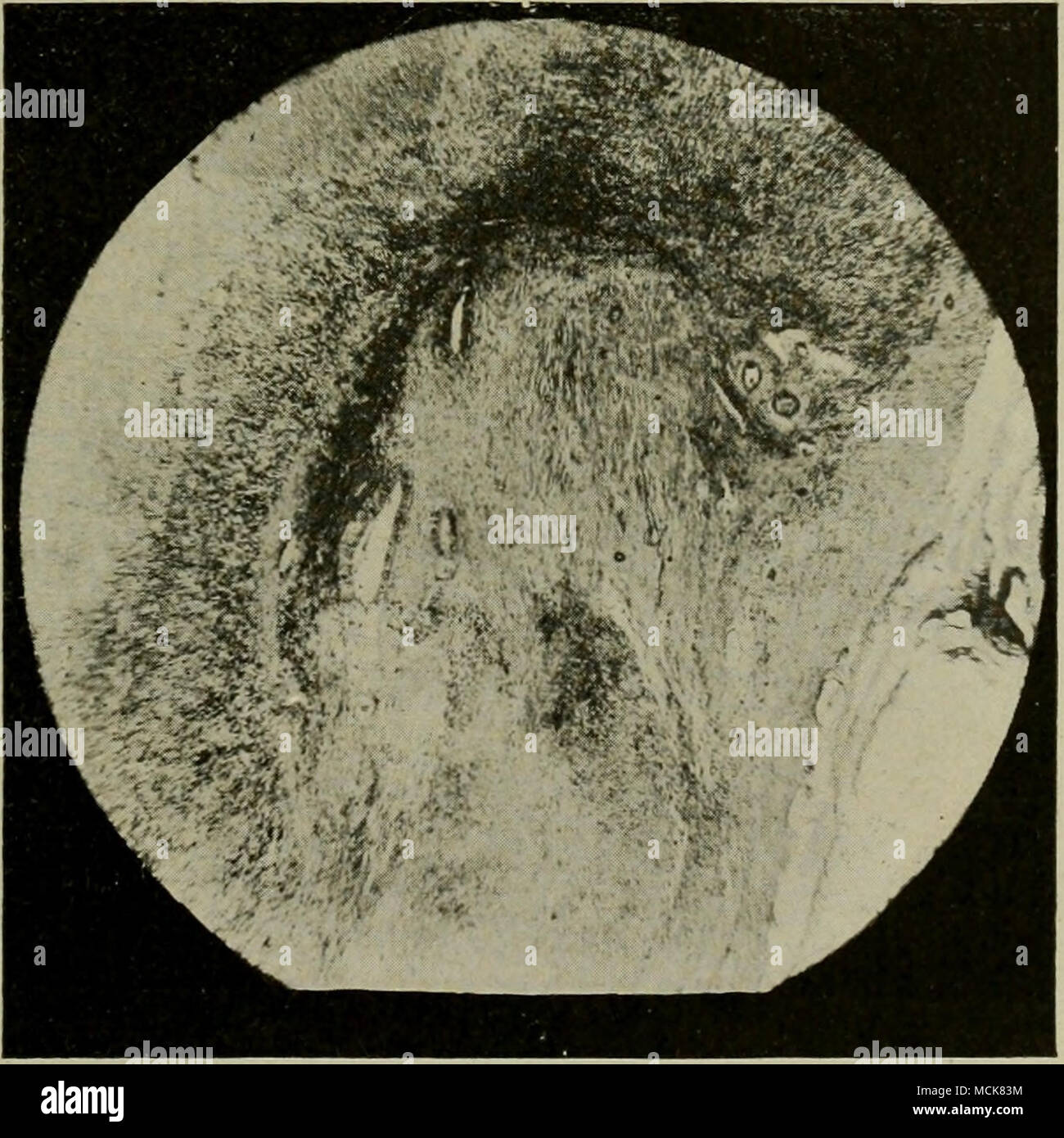 . Fig 153-Section de la partie du mur dans un vieux cas de salpingites tuberculeuses. Près du centre de la section sont vu trois cavités bordées -avec l'épithélium, qui ont résisté à la processus nécrotique. utérus surmonter rapidement si possible. Le vétérinaire et l'éleveur doit bien comprendre qu'un conservés après l'accouchement est une chose dangereuse pour l'intégrité des oviductes. Par conséquent, les bénéfices non placenta doivent être surveillées, non seulement du point de vue de sauver la vie de l'animal ou de simplement prévenir une métrite grave, mais à cause de la Banque D'Images