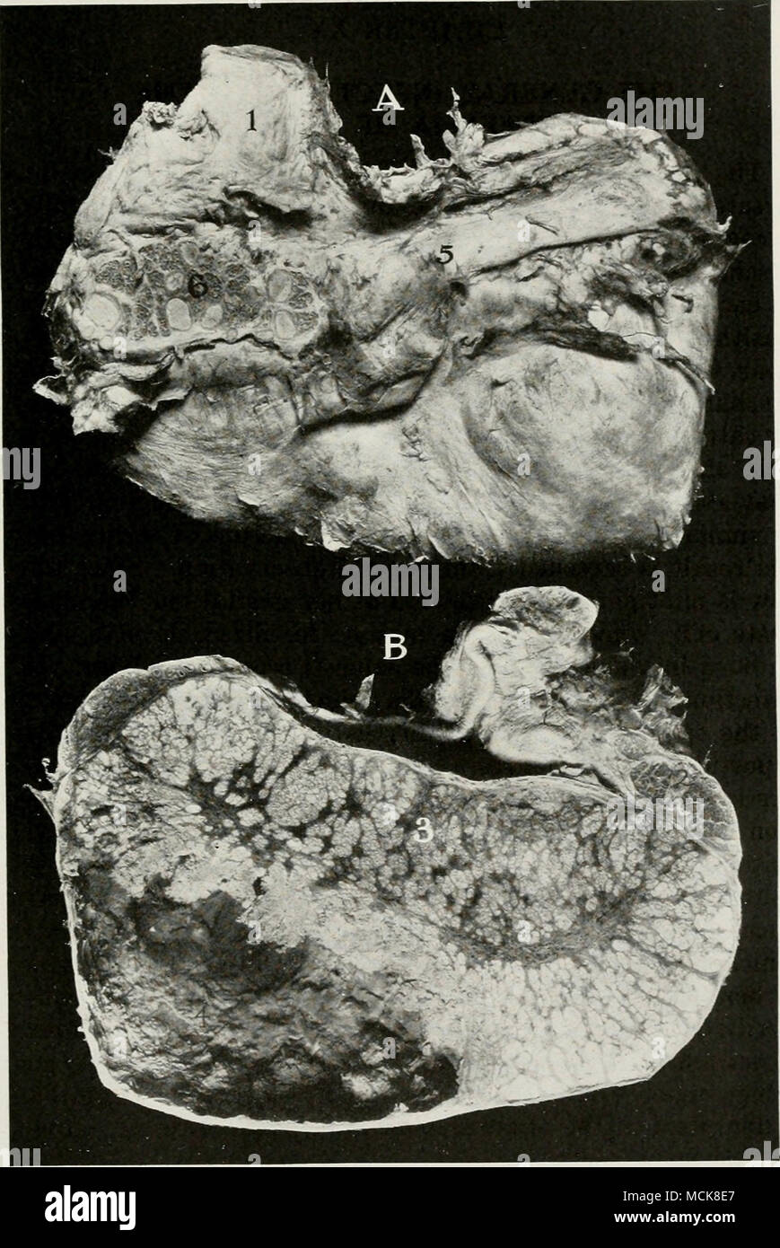 . Fig. 215-Tuberculose du testicule. Sanglier. Une section médiane, : B, côté extérieur de testicule montrant l'épididyme. / Cordon spermatique, ; 2, chef de l'épididyme ; j, masses tuberculeuses ; 7, tuber- cavitv abcès ; 5, corps de l'épididyme : 6, section à travers l'épididyme révélant des masses tuberculeuses. 47 Banque D'Images
