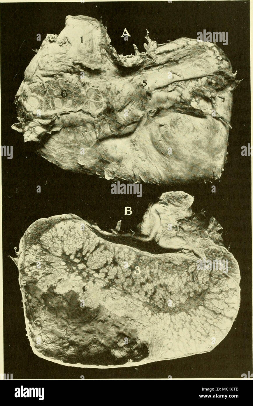 . Fig. 215-Tuberculose du testicule. Sanglier. A, B, section médiane ; face externe du testicule montrant l'épididyme. / Cordon spermatique, ; 2, chef de l'épididyme ; 3, 4 ; masses tuberculeuses, tuber- culière cavité ; abcès 5, corps de l'épididyme : 6, section à travers l'épididyme révélant des masses tuberculeuses. 47 Banque D'Images